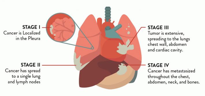 Pleural Mesothelioma: Stages, Symptoms, Causes And Treatment