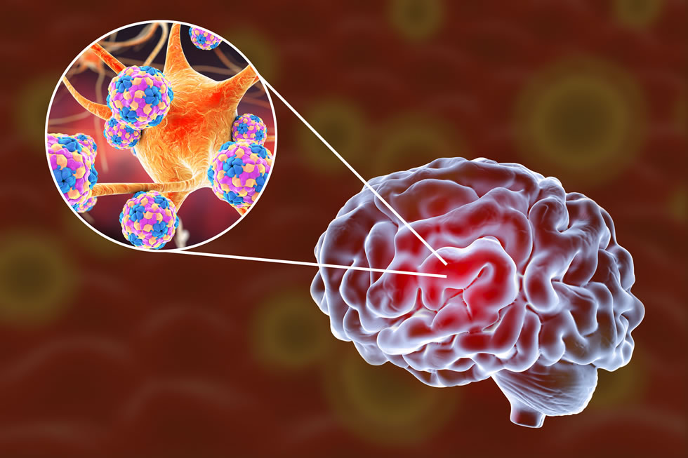 World Encephalitis Day 2019: When Is? Everything You Need To Know!