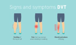 These Are The 5 Natural Ways To Deal With DVT (Deep Vein Thrombosis)